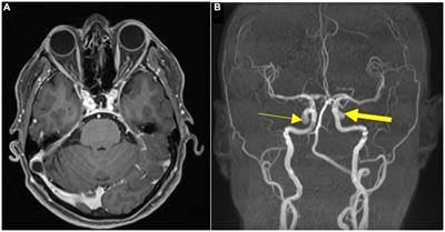 Case report: Mirror paraclinoid aneurysm associated with mirror clinoidal meningioma